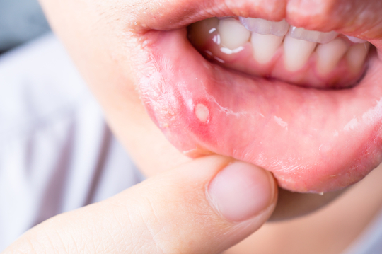 が ん 口内炎 子供 子供の口内炎はなぜできるの？原因と治療、自宅での対処法