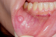 ない 口内炎 治ら 治らない・たくさん・大きい口内炎は病気のサイン？考えられる病気と対処法